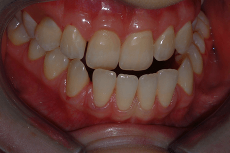 Primo piano di denti con incisivi superiori e inferiori disallineati e gengive rosse.