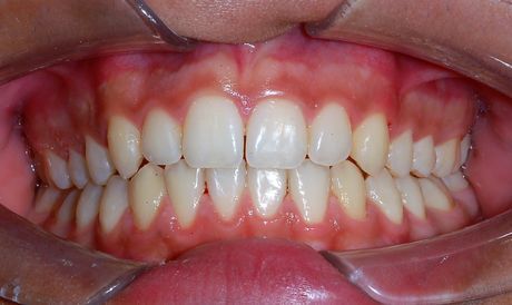Primo piano di una bocca sorridente che mostra denti bianchi allineati e gengive rosa, con un divaricatore dentale visibile.