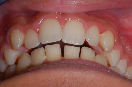 Primo piano della bocca di una persona che mostra denti affollati con uno spazio visibile tra gli incisivi centrali.