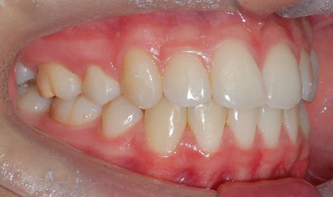 Primo piano di denti con affollamento dentale sia nell'arcata superiore che in quella inferiore e gengive rosa ben visibili, in vista laterale.