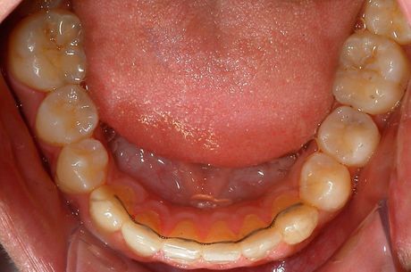 Primo piano dell'interno della bocca che mostra i denti inferiori e le gengive con macchie gialle.
