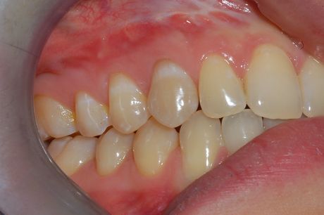 Primo piano di denti e gengive disallineati all'interno di una bocca, con evidente sovramorso e sovrapposizione dei denti anteriori.