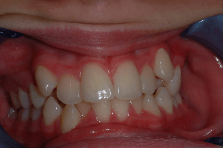 Primo piano di denti con incisivi affollati e malocclusione visibile