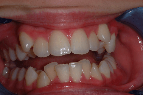 Primo piano di denti con incisivi superiori e inferiori affollati e storti, a bocca aperta.