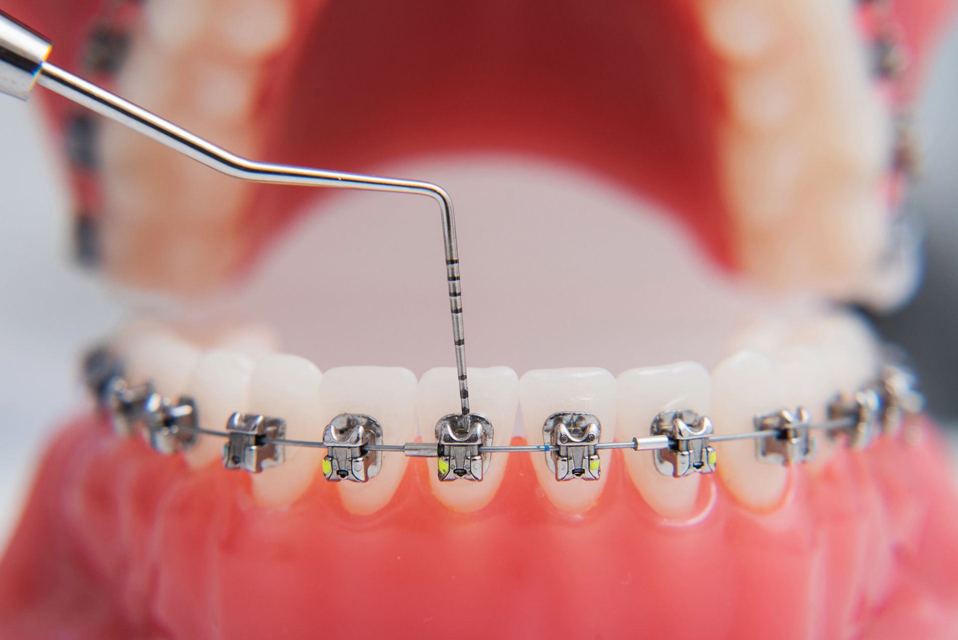 Regolazione dell'apparecchio ortodontico su denti e gengive mediante uno strumento apposito.