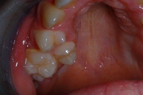 Primo piano di denti e gengive all'interno della bocca, che mostra un'otturazione o un accumulo di colore bianco.