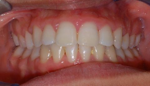 Primo piano di una bocca che mostra denti e gengive, con un piccolo spazio tra gli incisivi superiori.
