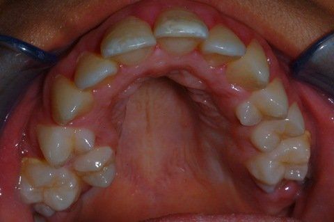 Primo piano di una bocca aperta che mostra i denti superiori e il palato durante una visita odontoiatrica.