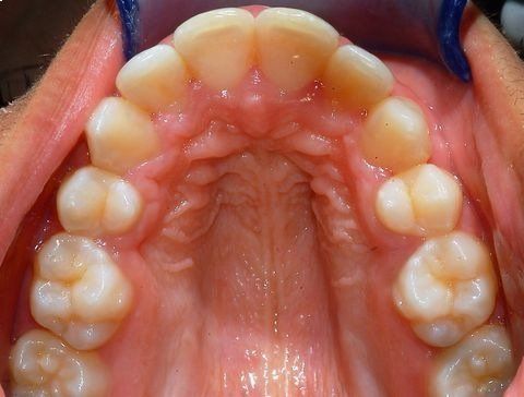 Primo piano del palato superiore e dei denti, che mostra il tetto della bocca e l'arcata dentaria.