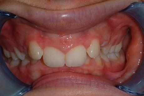 Primo piano di denti con un divaricatore dentale, che mostra i denti incisivi superiori e le gengive in una bocca