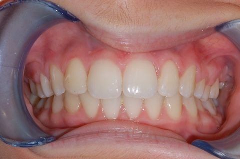 Primo piano dei denti con un divaricatore dentario per le guance che mostra l'allineamento dei denti frontali superiori e inferiori.