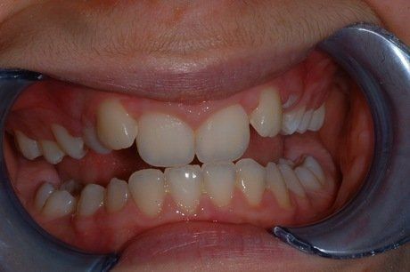 Primo piano della bocca di un bambino con l'apparecchio ortodontico, che mostra i denti disallineati e un divaricatore dentale.