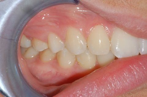 Primo piano di denti umani con incisivi affollati e disallineati e gengive rosa.