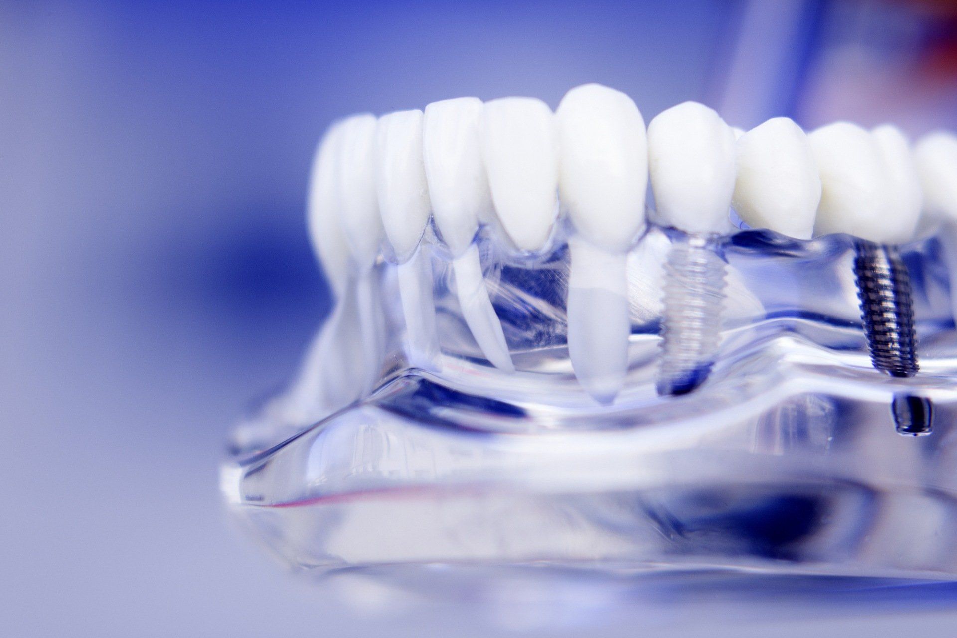 Modello di impianto dentale con denti bianchi e viti metalliche su base trasparente su sfondo blu.