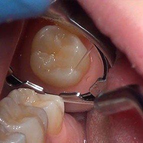 Completed Dental Sealant placed using the Nu-bird Bird HVE Mirror system.