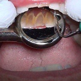 Nu-bird dental HVE mirror offer clear indirect view of during a dental cleaning procedure.