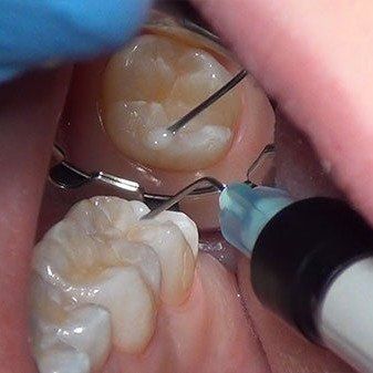 Dental sealant placement in progress using the Nu-bird mirror for evacuation with clear visibility keeping a dry field.