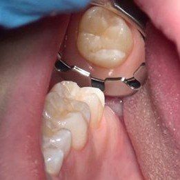 Dental view: clear indirect view of an upper molar using the Nu-Bird evacuation mirror system.