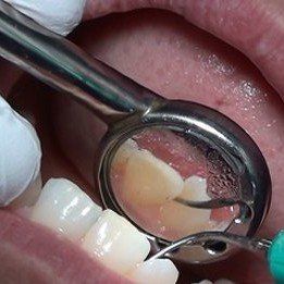 Clear indirect vision using ultrasonic scaling device on upper anterior lingual teeth during a dental cleaning procedure.