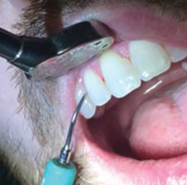 Dental hygienist cleaning teeth with scaler and mirror.