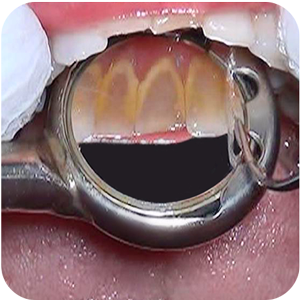 Lower indirect clear view with Nu-bird mirror
