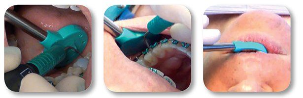 Cheek retraction with Nu-bird HVE evacuation mirror during ultrasonic scaling procedure.