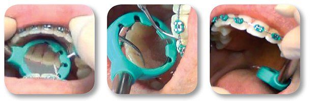 Indirect vision with Nu-bird evacuation mirror during ultrasonic procedure. See how clear the mirror stays...