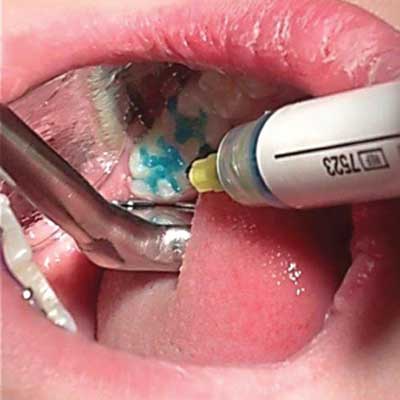 Placing etchant on occlusal of molar using Nu-bird HVE mirror retractor to keep a dry field.