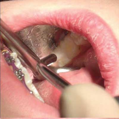 Rinsing etchant off of molar using Nu-bird HVE mirror.