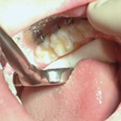 Mouth open, Nu-bird evacuation mirror retracting the cheek to show etched molar ready for sealant placement.
