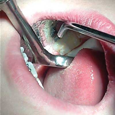 Blow dry etched tooth keeping Nu-bird evacuation mirror close to tooth while retracting tongue.