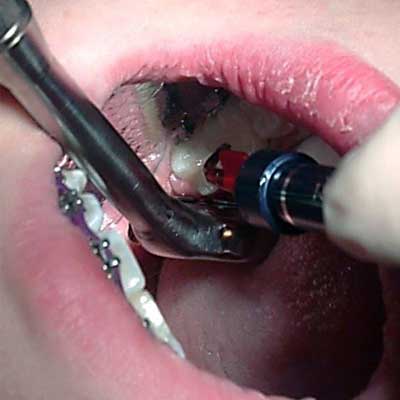 Keeping Nu-bird HV Mirror close to tooth keeping saliva away while dental light is curing the sealant placed.