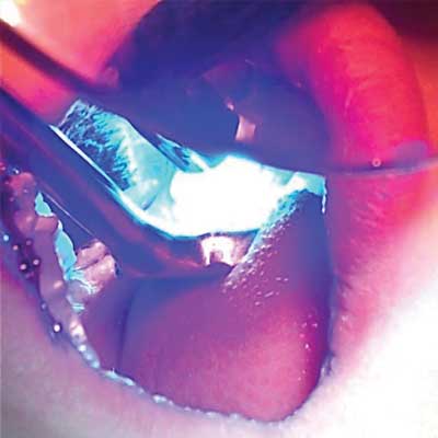 Light cure procedure of sealant using Nu-Bird HVE mirror system.