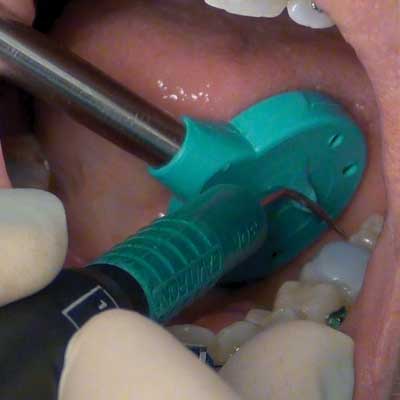 Dentist using a green tool inside a patient's mouth.