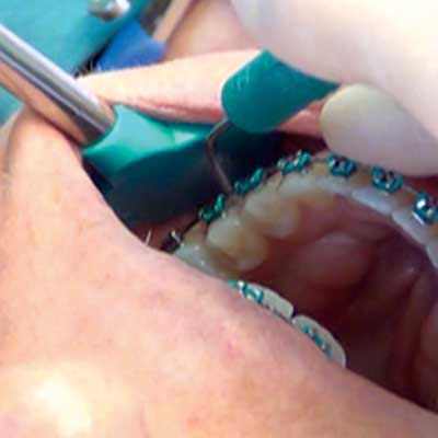 Dentist's hands using tools to adjust metal braces on a patient's teeth inside their mouth.