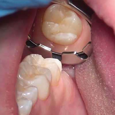 A dentist's view inside a mouth, showing a tooth surrounded by a metal dental dam.