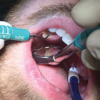 Dentist examining teeth with tools: scaler, mirror, and water spray; patient's mouth open in close-up view.