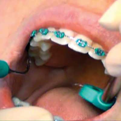 Close-up of a mouth with braces; an orthodontist uses tools to adjust the wire.
