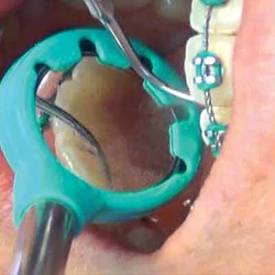 A dental procedure in progress. A turquoise cheek retractor holds open a mouth, with dental tools visible.