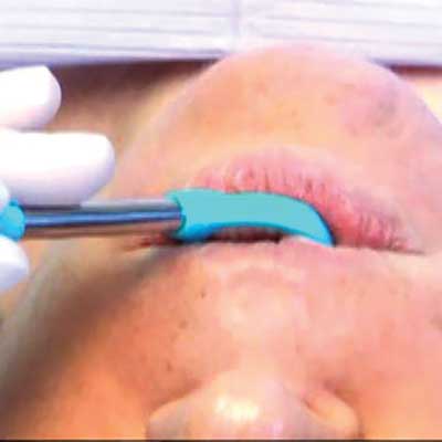 Person receiving a medical swab in their mouth, with gloved hand and blue instrument.