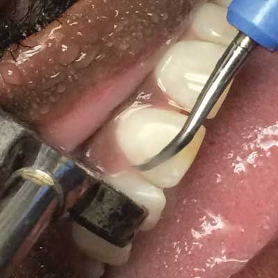 Dental hygienist cleaning teeth with a scaler, water spraying.