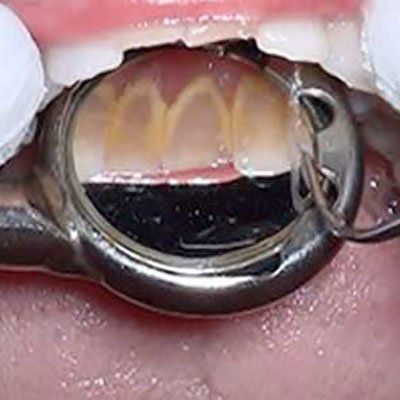 Dental mirror reflecting teeth; yellowing, possible staining visible.