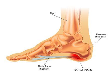 Plantar Faciitis