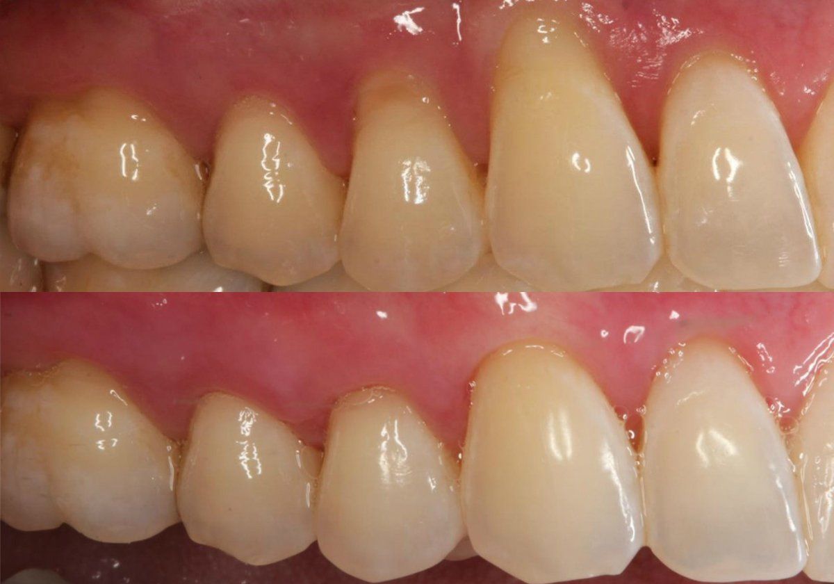 gum recession best dentist treatment near me