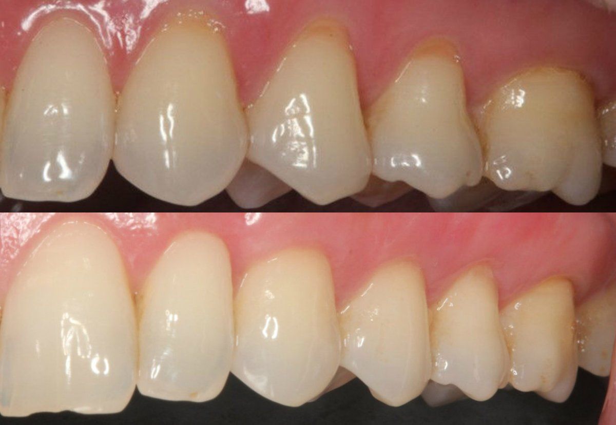 gum recession best dentist treatment near me