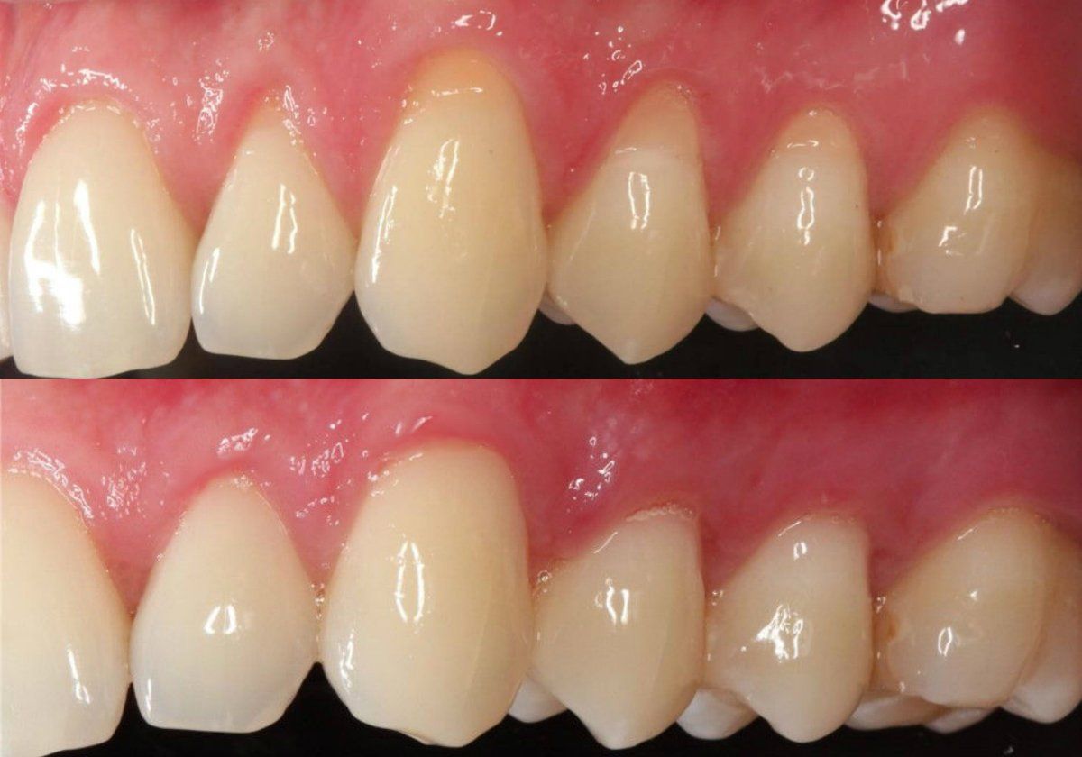 gum recession best dentist treatment near me