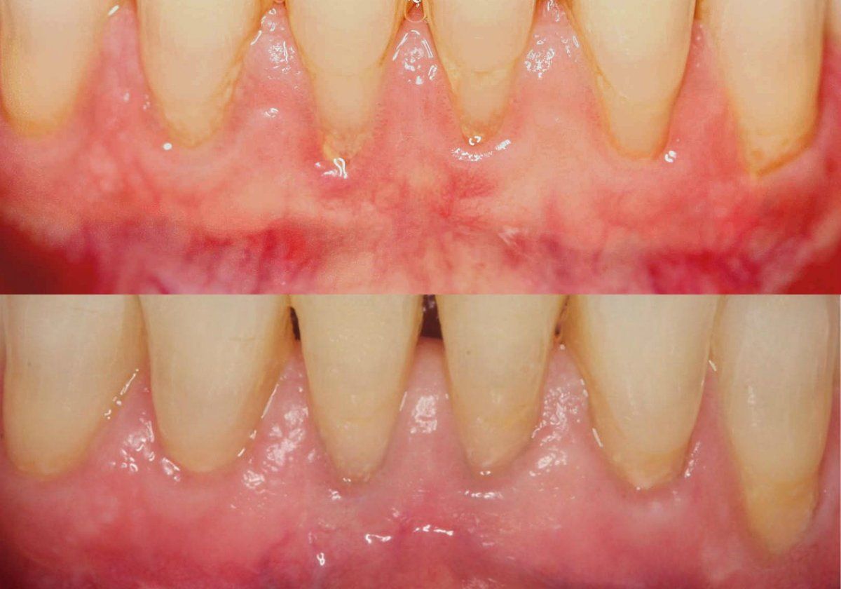 gum recession best dentist treatment near me