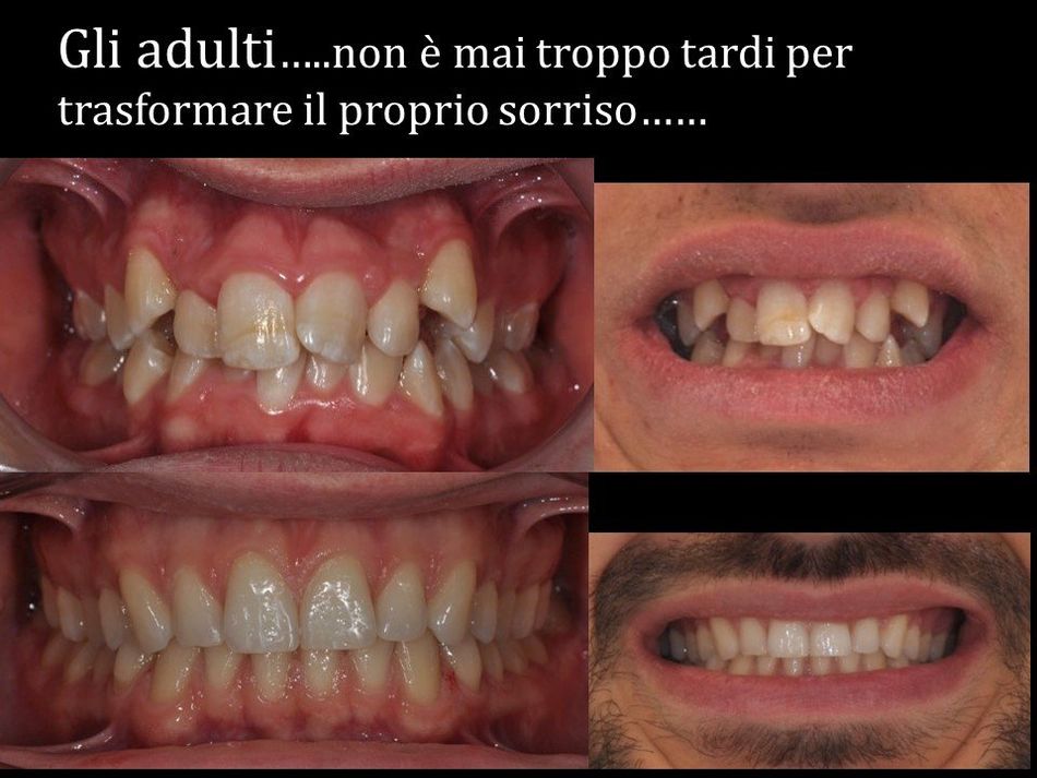 trattamenti denti storti