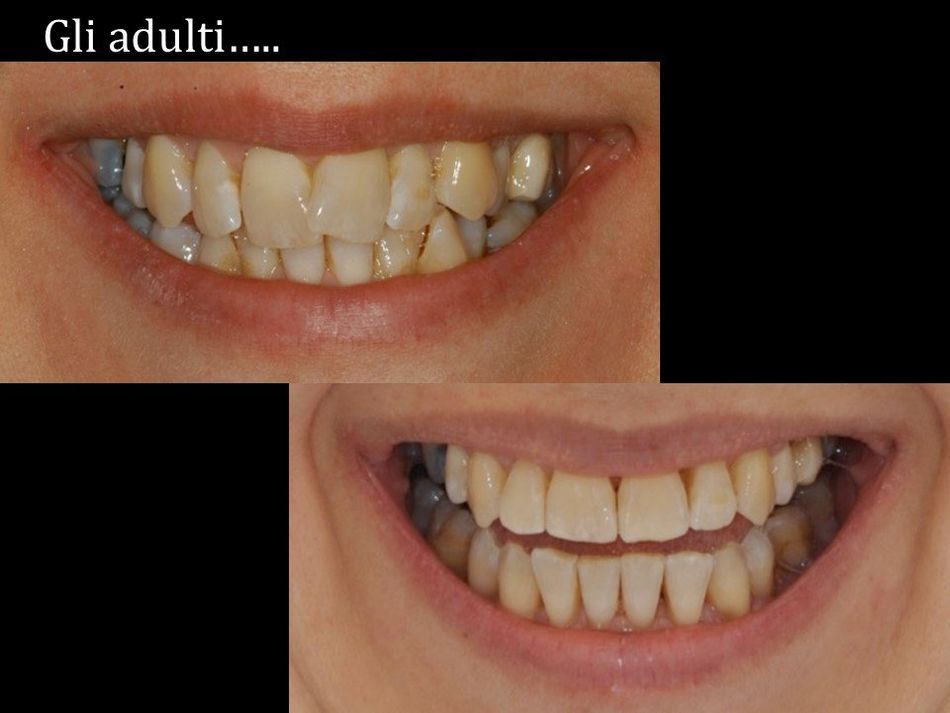 sbiancamento denti