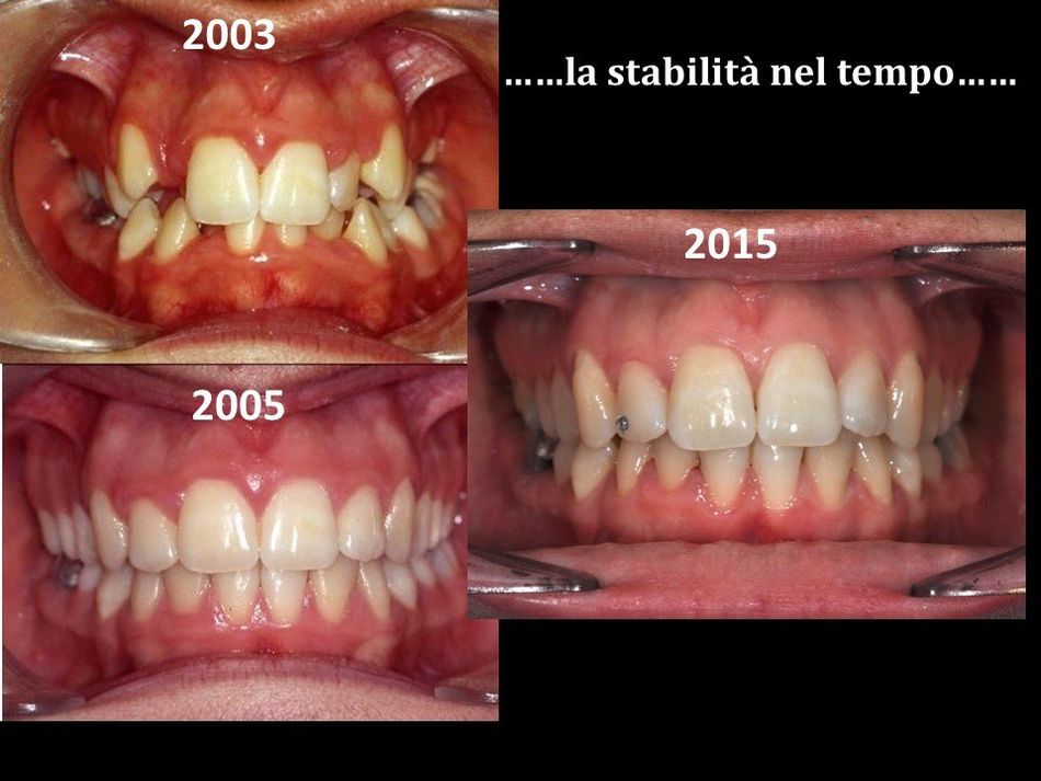 dentatura riallineata